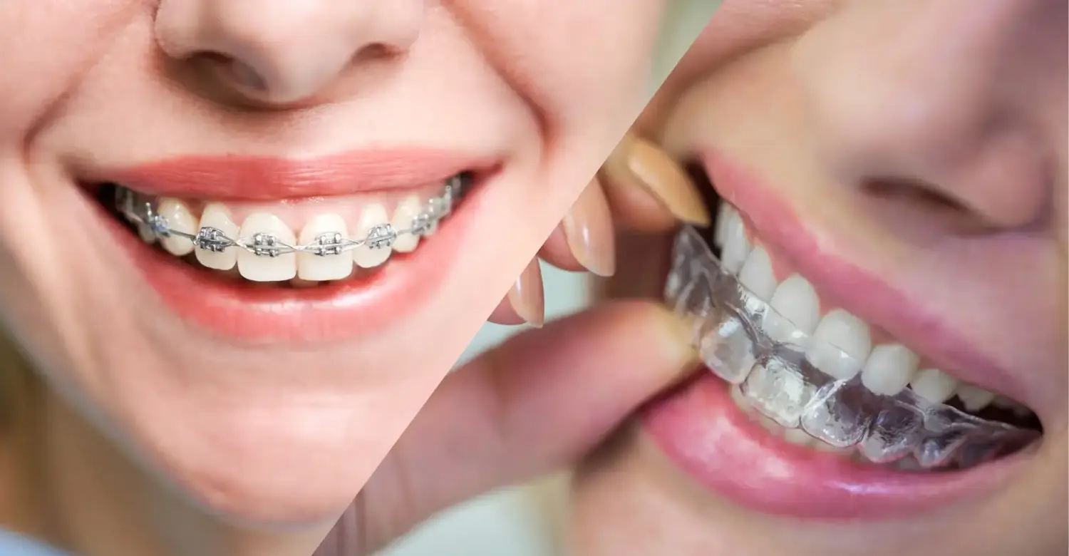 how to know if invisalign is right for orthodontic needs 2